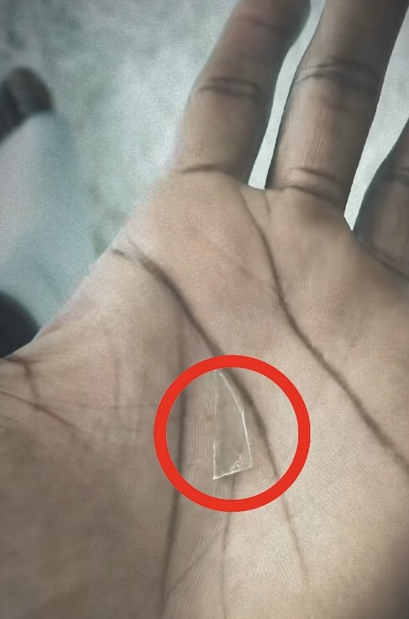 Insolite : Il a joué avec un morceau de verre dans le pied pendant 2 ans 11 Morceau de verre